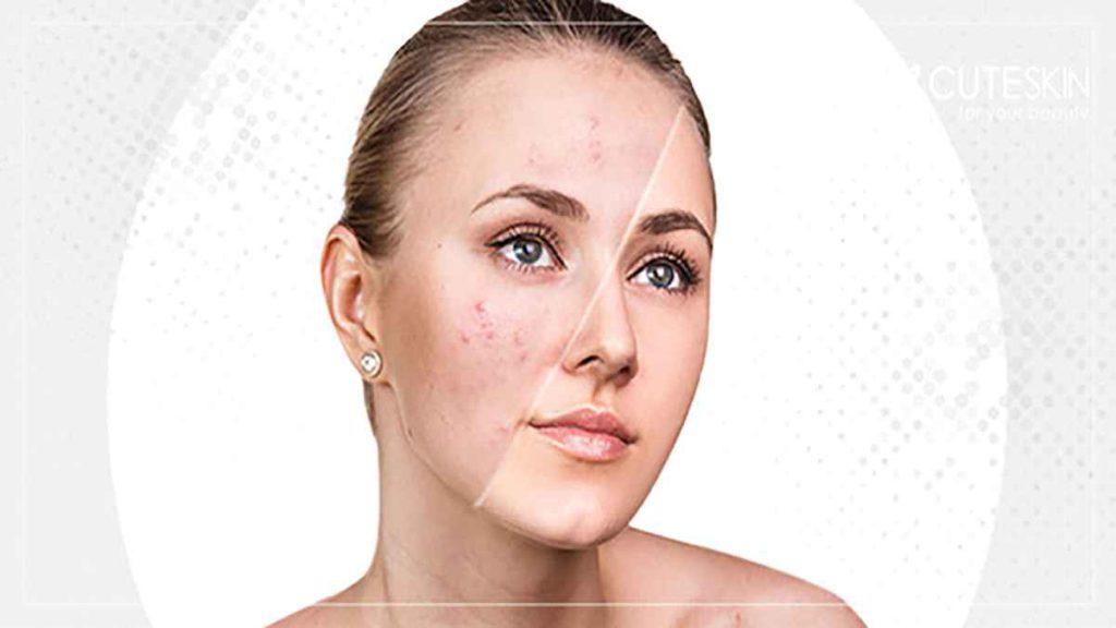 مزایای مزوتراپی