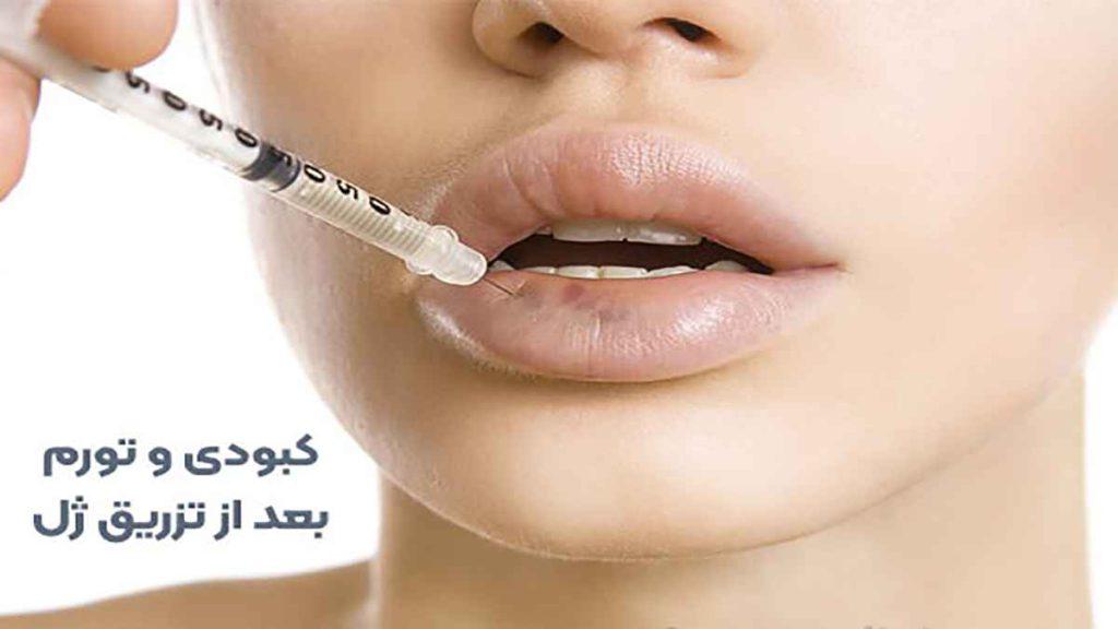 مراقبت بعد از تخلیه ژل پاژ