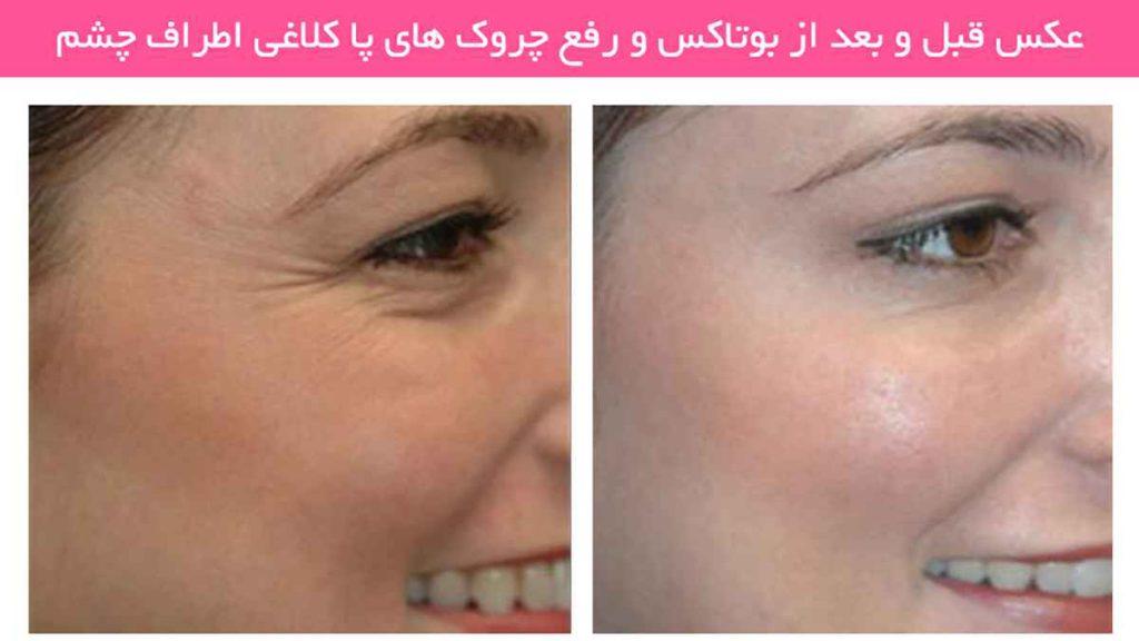 عوارض تزریق بوتاکس عوارض تزریق بوتاکس