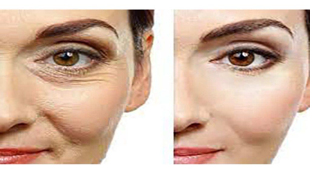 رفع چروک چشم با هایفوتراپی مقایسه قبل و بعد هایفوتراپی