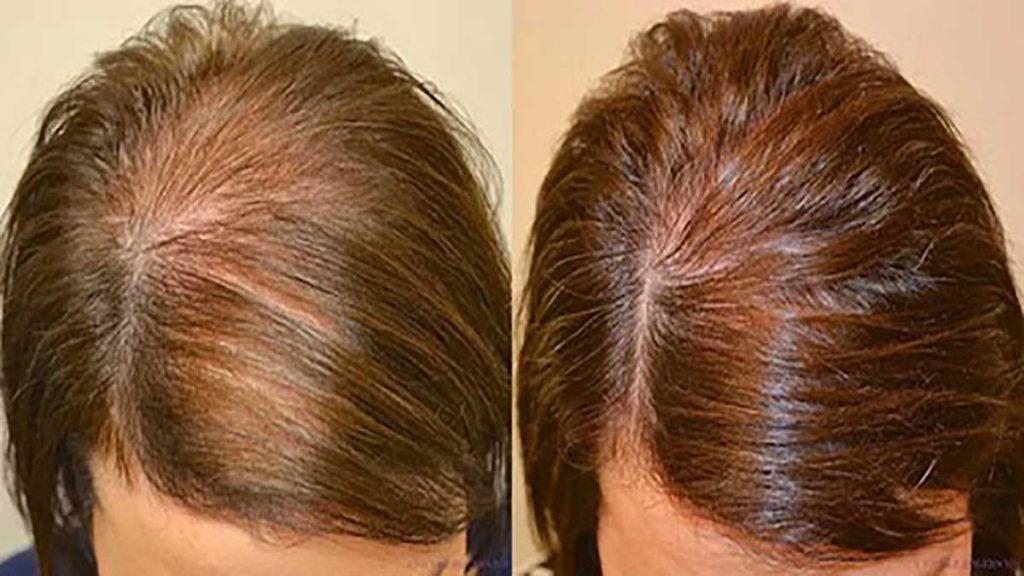 مقایسه درمان ریزش مو قبل و بعد