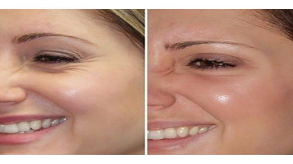 هایفوتراپی اطراف چشم هایفوتراپی اطراف چشم