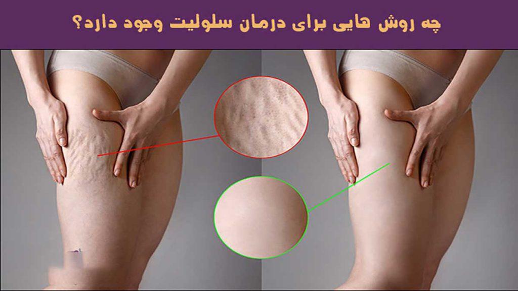 درمان سلولیت ران پا با هایفوتراپی