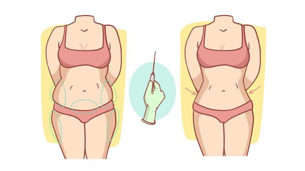 لاغری با امبدینگ یا کاشت نخ