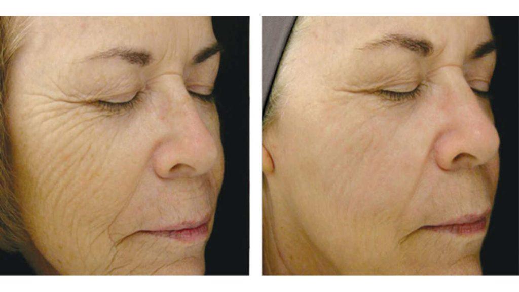 هایفوتراپی چروک اطراف چشم هایفوتراپی چروک اطراف چشم