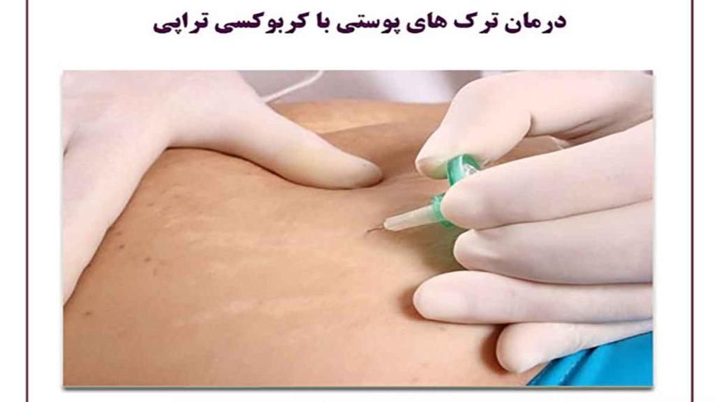 درمان ترک پوست با کربوکسی درمان ترک های پوست