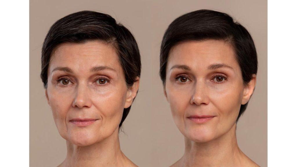  کاهش چین و چروک‌های صورت 