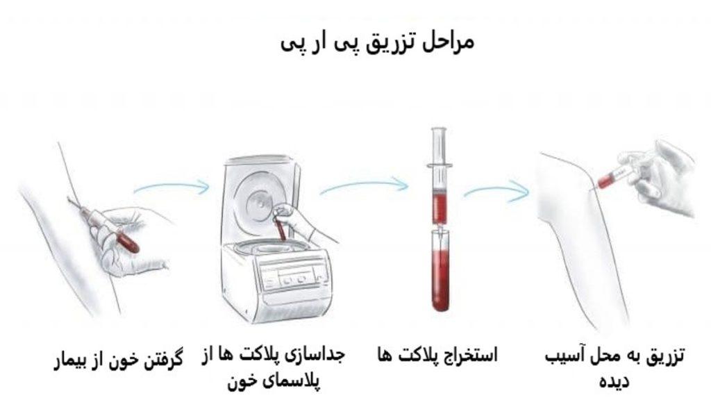 مراحل تزریق پی ار پی زانو در تهران