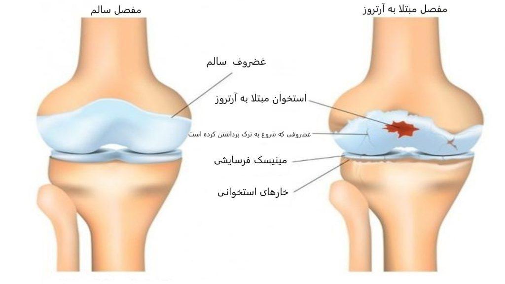 مفصل سالم و مفصل مبتلا به آرتروز
