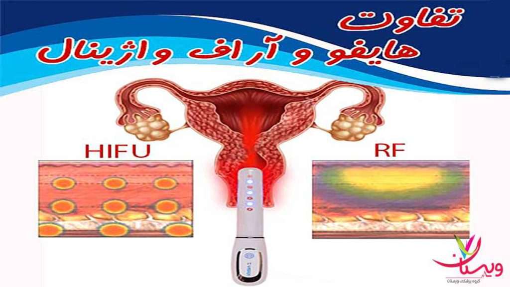 تفاوت هایفو وآر اف