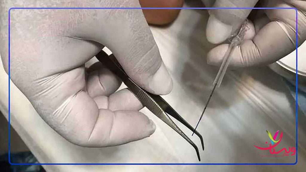 نخ لاغری پرسش های رایج درباره کاشت نخ