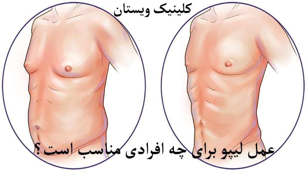 عمل لیپو شکم شخص عمل لیپو شکم و سینه انجام داده است