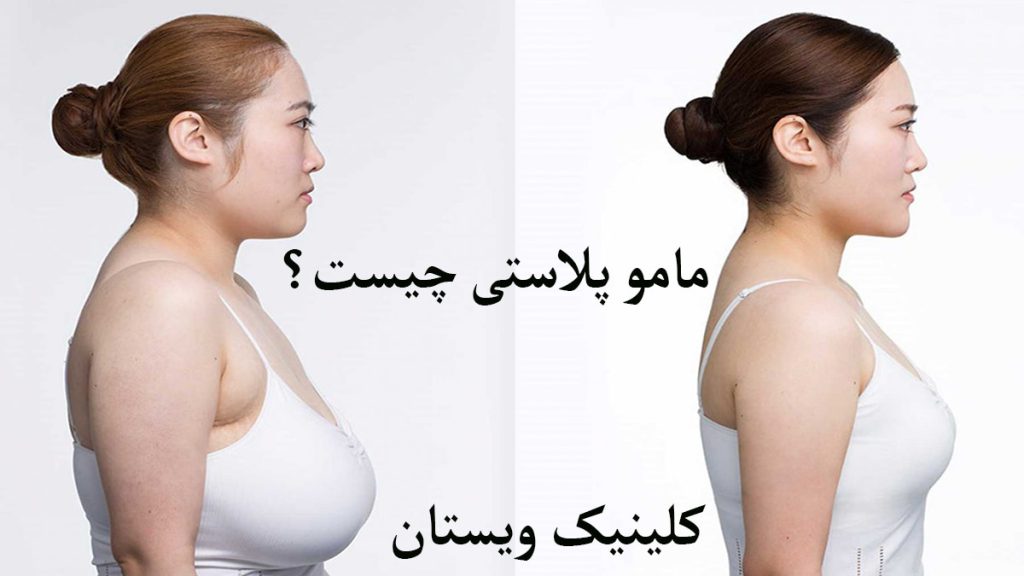 ماموپلاستی چیست؟شخصی این عمل را انجام داده و قبل و بعد از آن نمایش داده می شود