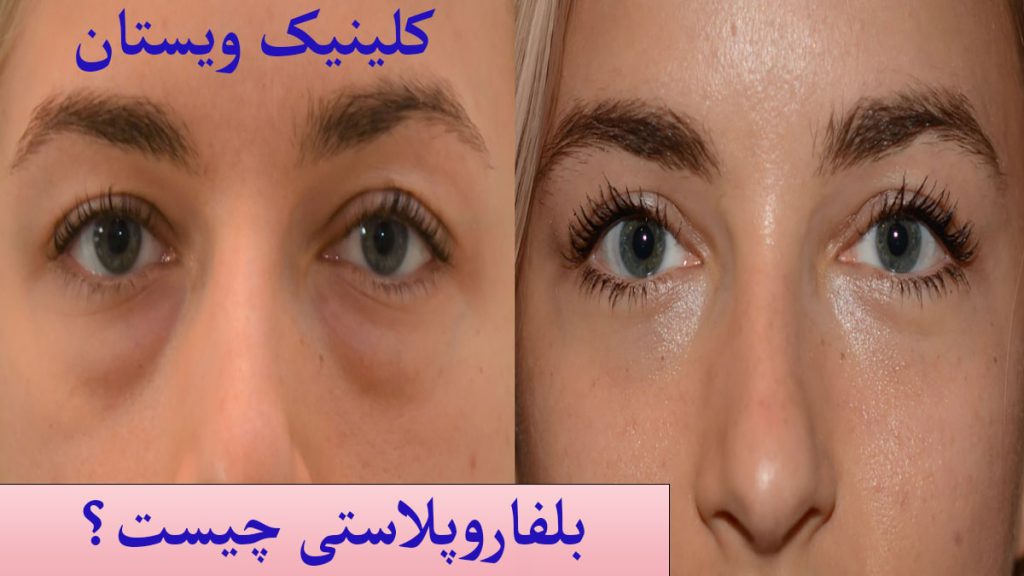 بلفاروپلاستی چیست نوشته ای در خصوص بلفاروپلاستی چیست؟و پلک های شخصی قبل و بعد از عمل بلفاروپلاستی نمایش داده می شود