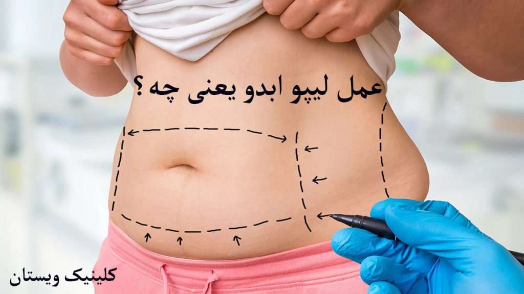 عمل لیپو ابدو پزشک در حال مشخص کردن ناحیه شکم بیمار برای عمل لیپو است