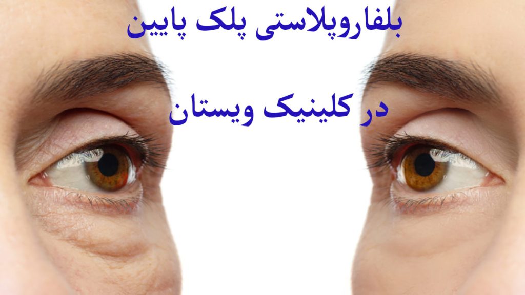 بلفارو برای پلک پایین عمل بلفاروپلاستی بر روی پلک پایین انجام شده است
