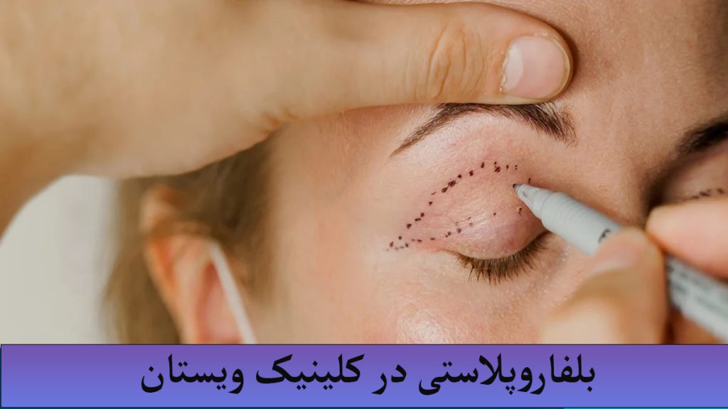 بلفارو پلاستی در کلینیک ویستان پزشک در حال انجام عمل بلفارو پلاستی برای شخص است