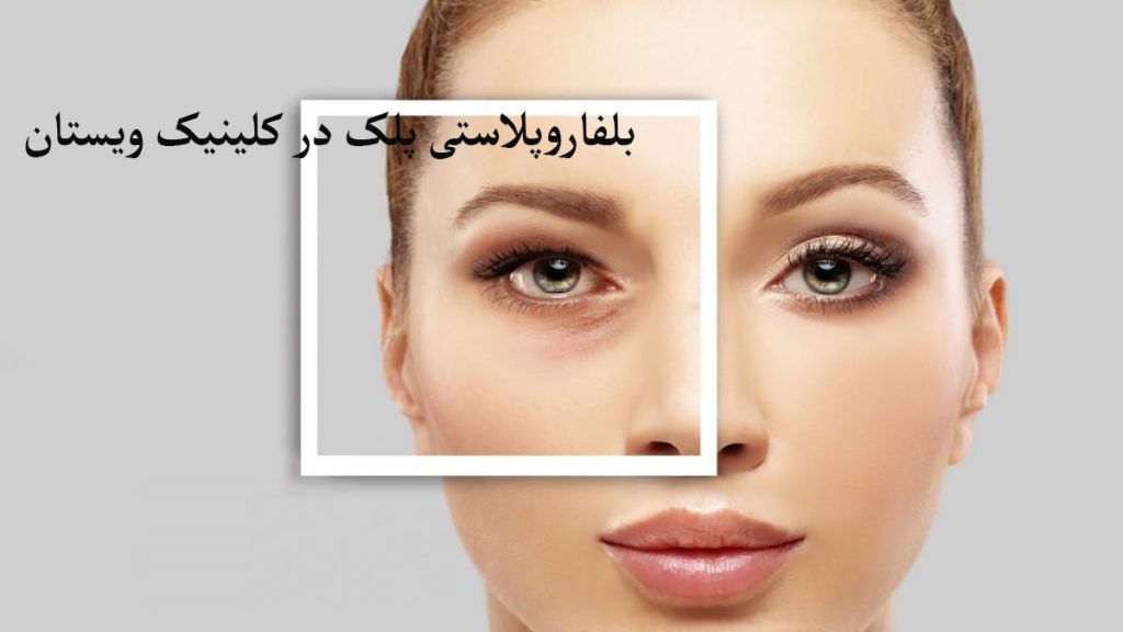 بلفاروپلاستی پلک شخصی عمل بلفاروپلاستی در کلینیک ویستان انجام داده است