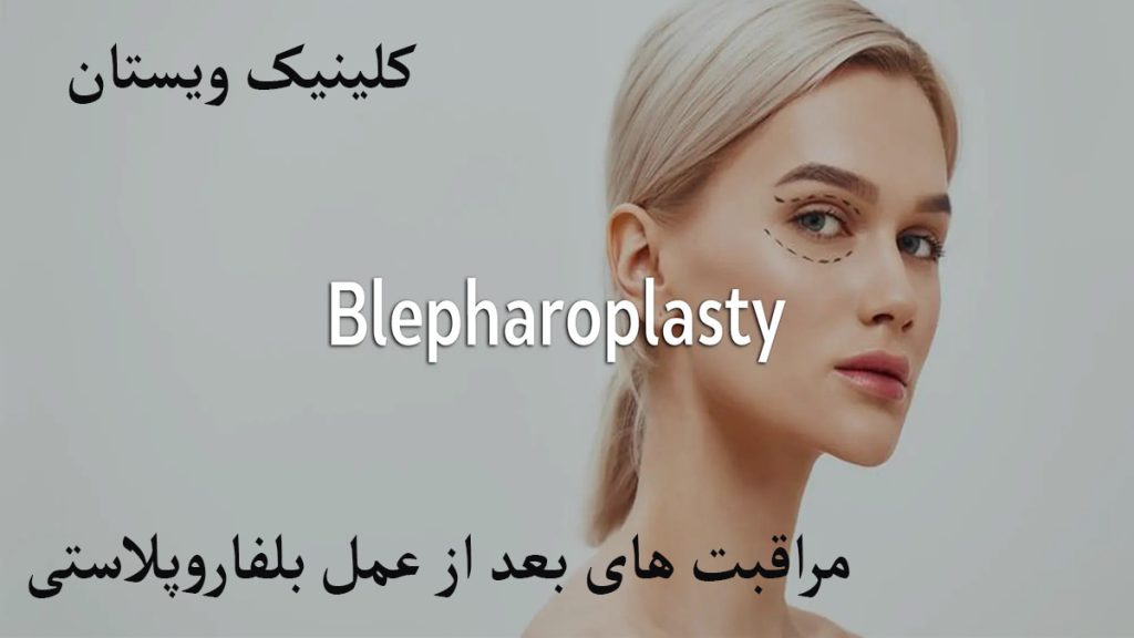 مزاقبت بعد زا عمل بلفارو نوشته ای درباره مراقبت بعد از عمل بلفارو همراه با شخصی که بلفارو انجام داده است