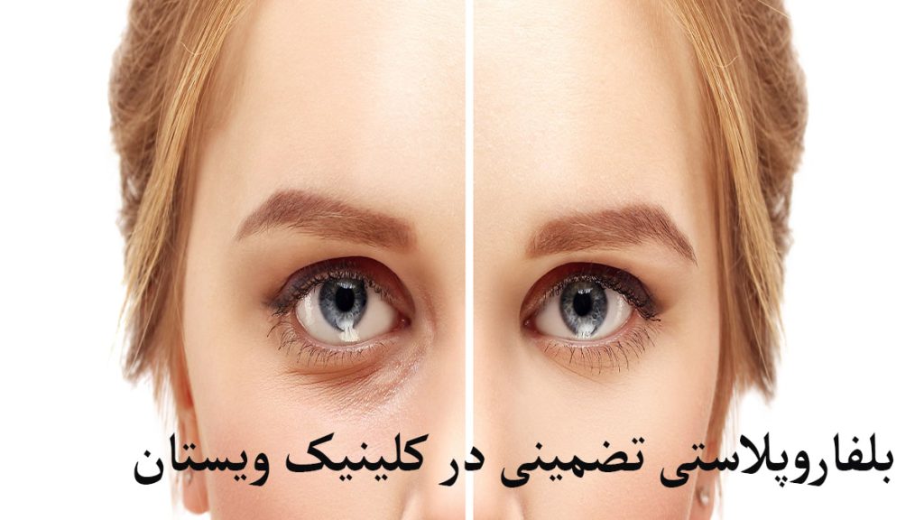 بلفارو ویستان قبل و بعد عمل بلفاروپلاستی پلک نمایش داده می شود