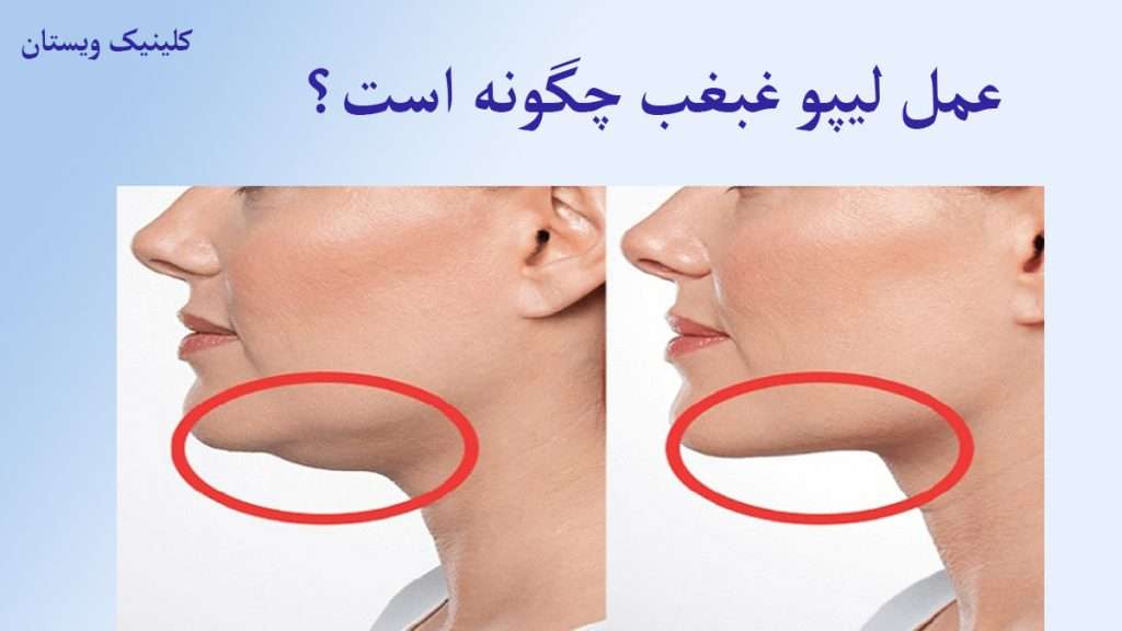 لیپو غبغب غبغب فرد قبل از عمل لیپو و بعد از آن نمایش داده می شود