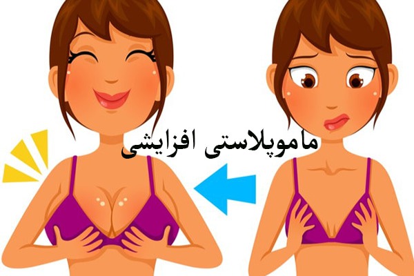 شخصی ماموپلاستی افزایشی انجام داده است