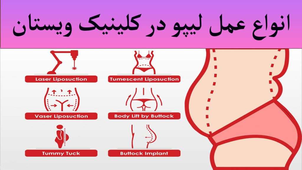 عمل لیپو انواع عمل لیپو شکم ، ران و دیگر نقاط بدن نمایش داده می شود