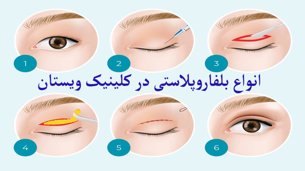 عمل بلفارو برای پلک مراحل مختلف عمل بلفاروپلاستی نمایش داده می شود