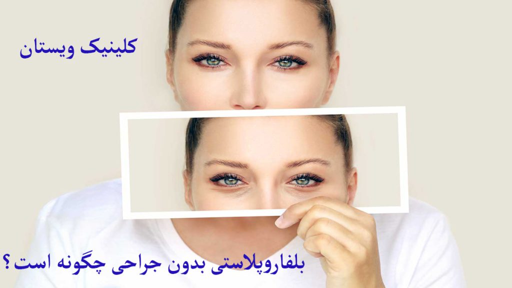 بلفاروپلاستی بدون جراحی شخصی عمل بلفاروپلاستی برای زیبایی پلک انجام داده است