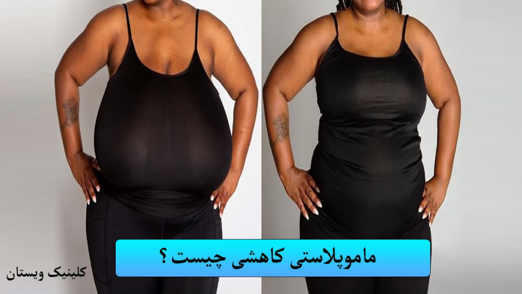 شخصی ماموپلاستی کاهشی انجام داده است