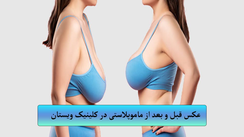 نتایج ماموپلاستی نشان داده شده است