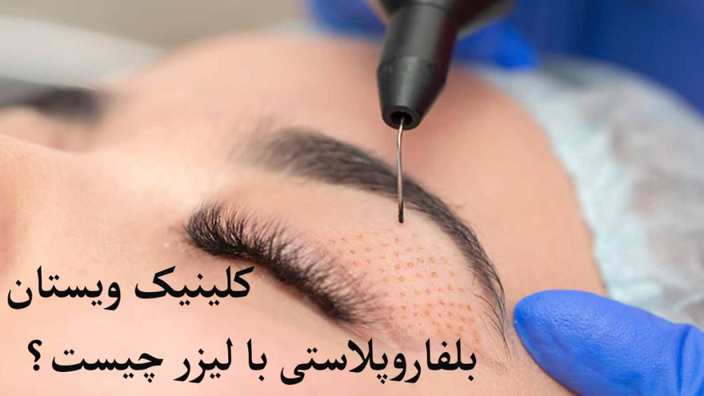 بلفاروپلاستی با لیزر بلفاروپلاستی با لیزر برای شخص انجام می شود