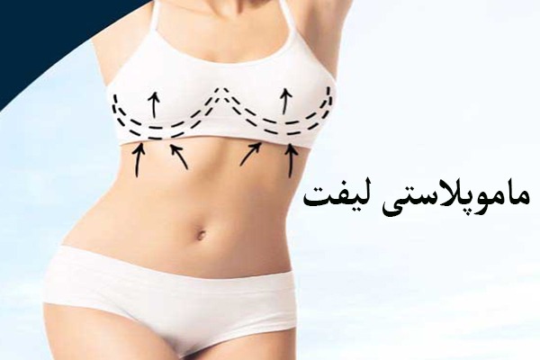ماموپلاستی لیفت برای خانمی انجام شده است