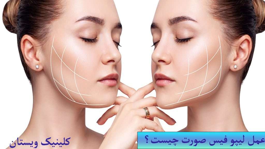عمل لیپو صورت شخصی صورتش را عمل لیپو کرده است