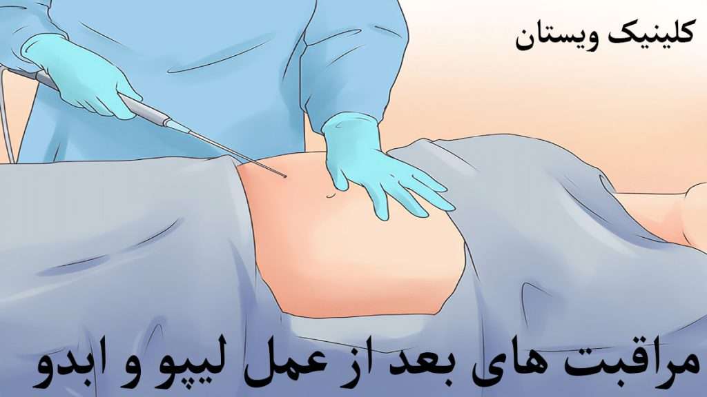 مراقبت بعد از لیپو عمل لیپوی شکم توسط پزشک متخصص نمایش داده می شود
