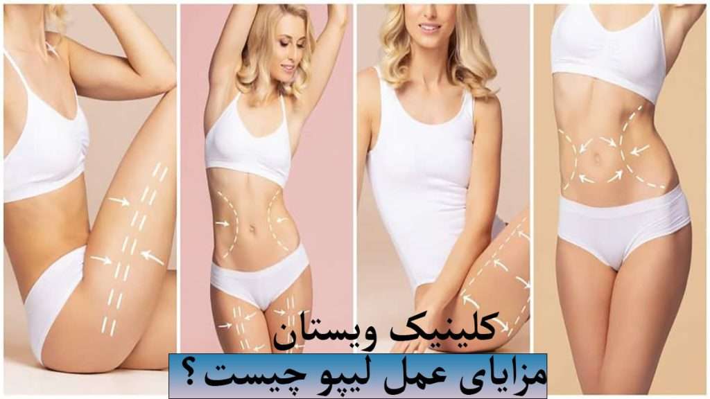 مزایا عمل لیپو لیپو در قسمت های مختلف بدن فرد نمایش داده می شود