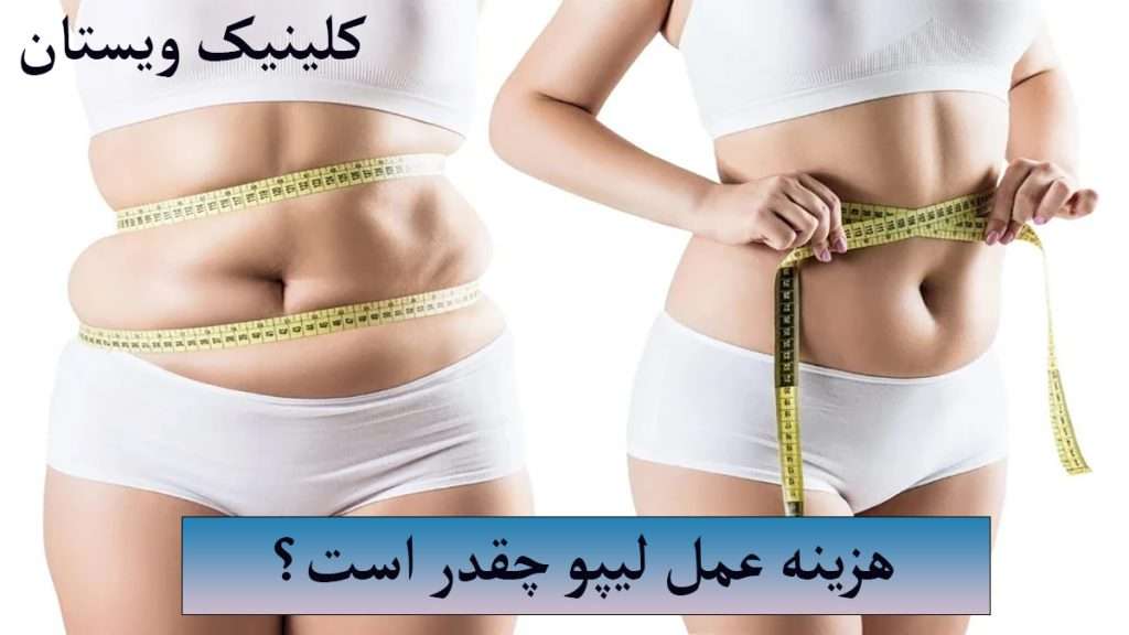 هزینه لیپوی شکم شخصی لپو شکم انجام داده است