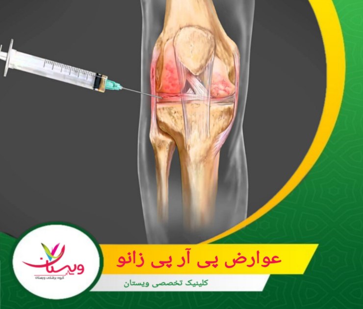 واکنشهای آلرژیک نادراً ممکن است رخ دهند. عوارض پی آر پی زانو