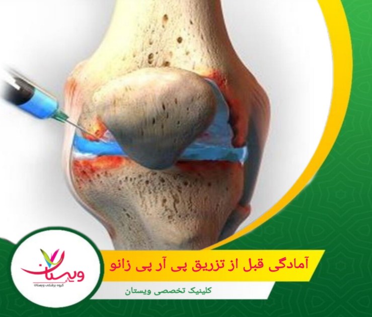 حداقل یک هفته قبل از تزریق از مصرف داروهای ضد التهابی مانند ایبوپروفن و آسپرین خودداری کنید. آمادگی قبل از تزریق پی آر پی زانو