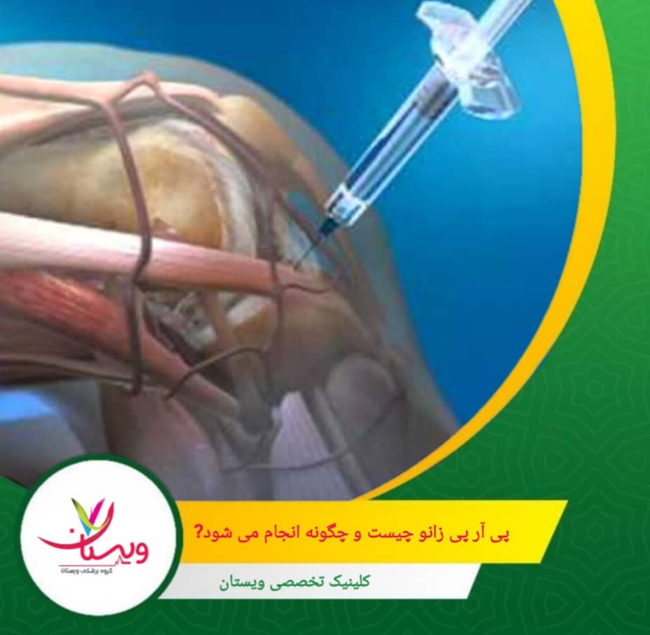 پی آر پی زانو چیست و چگونه انجام می شود؟