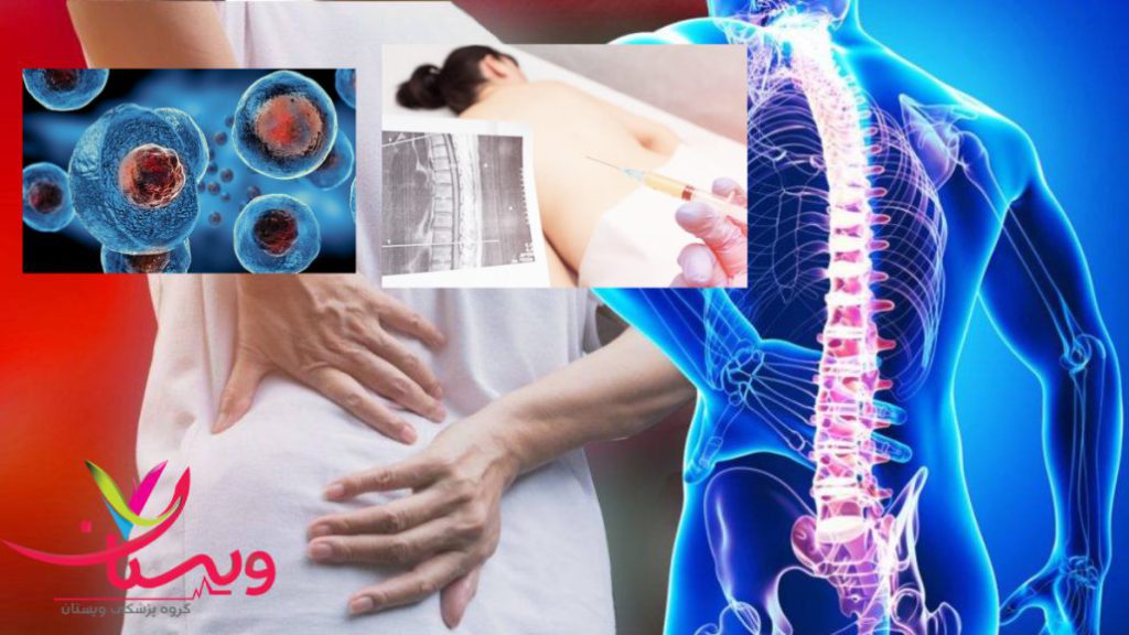 قیمت سلول بنیادی برای کمر
