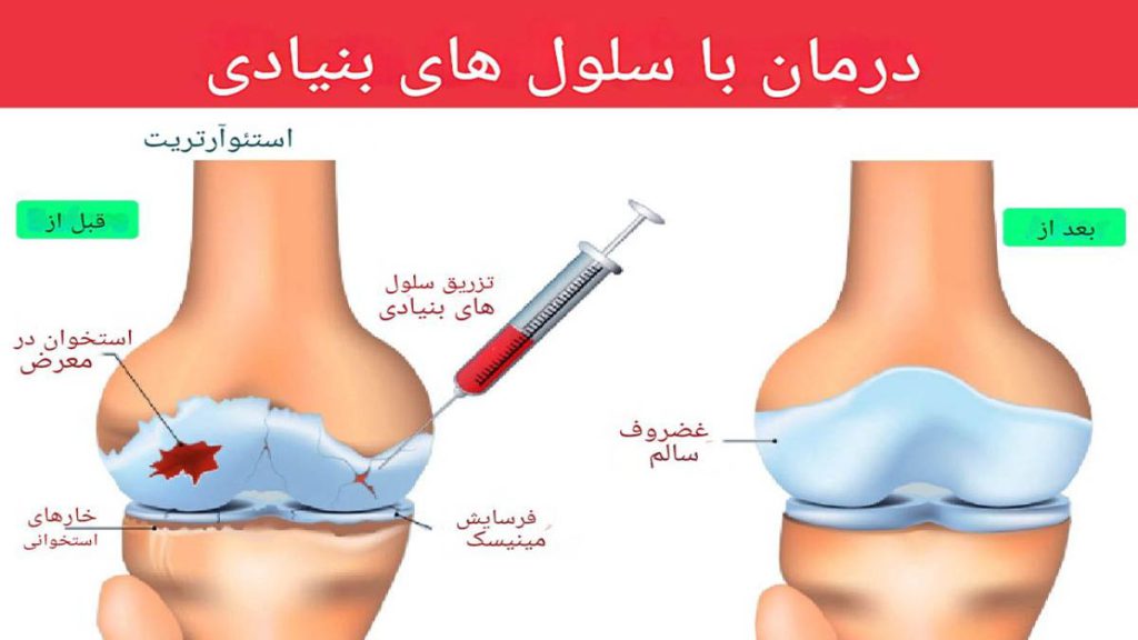 مزایای تزریق سلول بنیادی به زانو
