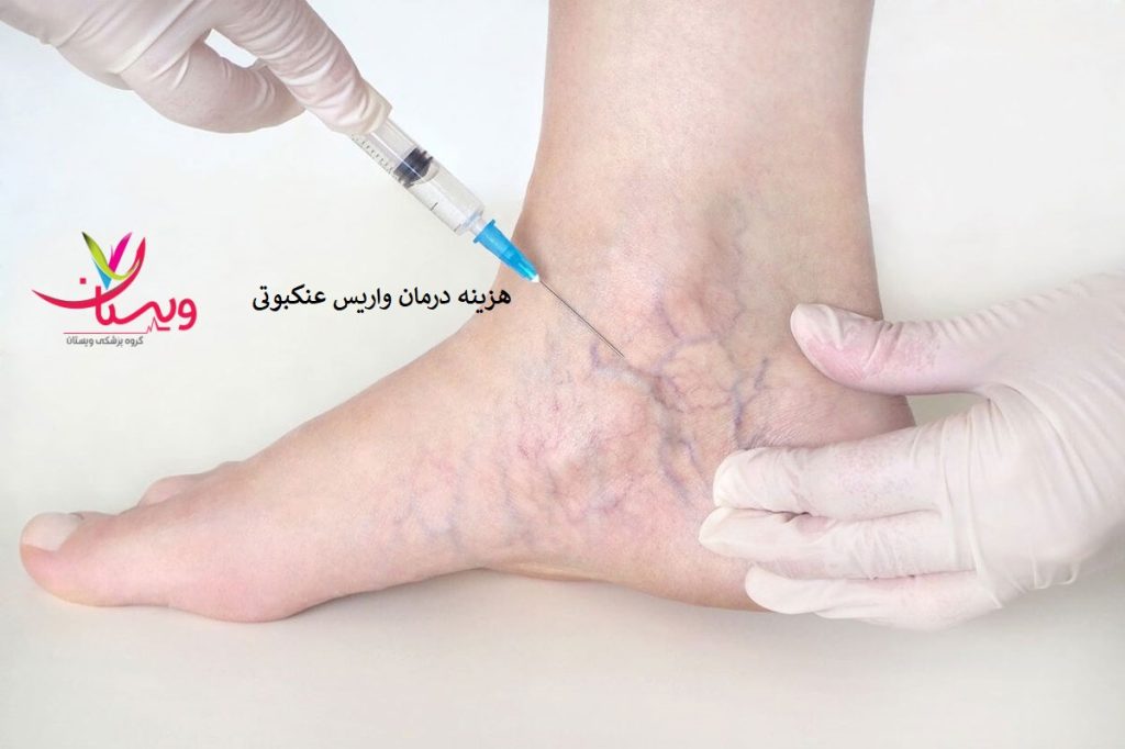 هزینه درمان واریس با تزریق