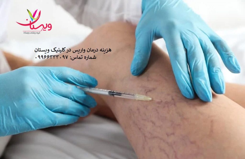 هزینه درمان واریس