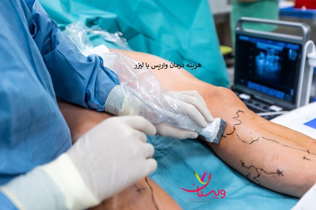 هزینه درمان واریس با لیزر