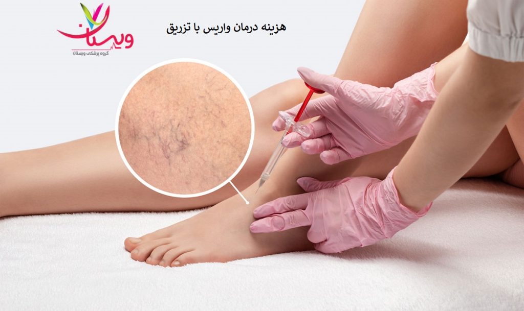 هزینه درمان واریس با تزریق
